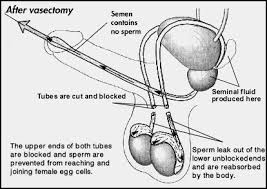 Vasectomy surgery usually takes about 10 to 30 minutes. Where Does Sperm Go After Vasectomy Pollock Clinics