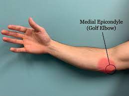The pain associated with tennis elbow may radiate from the outside of your elbow into your forearm and wrist. Tennis Elbow Versus Golf Elbow Capital Chiropractic
