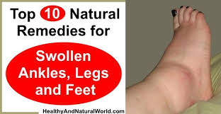 Pin On Natural Remedies