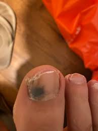 It's been a big debate about whether uv lamps cause skin cancer, but the truth is finally in. Toenail Melanoma Melanoma
