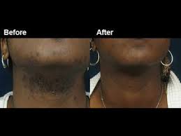 Using laser light energy to penetrate black skin responds well to only one type of laser, the nd: Laser Hair Removal Miami Advice For Black Men Women Youtube