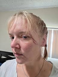 Do anyone get bad headaches after surgery