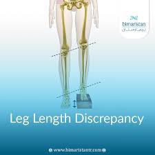 Image result for Functional Leg Length Discrepancy
