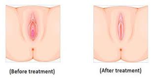 عمليات تجميل الأعضاء التناسلية بالصور عمليات تجميل الأعضاء التناسلية للمرأه تکلفة و نتائج