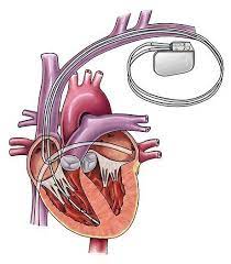 If you or your loved one had or has a potentially defective icd or pacemaker. Implantable Cardioverter Defibrillator Icd Pacemaker Surgery Htw