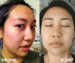 Talk to a dermatologist near you. Can Allergies Cause Cystic Acne Spoiler Alert Food Allergies And Acid Reflux Were The Cause Of My Allergy Acne Sarah Chetrit S Lust Till Dawn