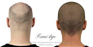 Cos'è la tricopigmentazione o micropigmentazione del cuoio capelluto. Tricopigmentazione