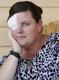 Melanoma QLD: Cases misdiagnosed, undetected