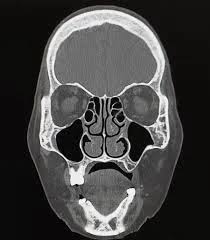 Image result for Sinus CT