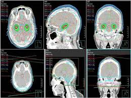 Tailored Radiation For Brain Metastases Reduces Cognitive Impact National Cancer Institute