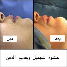 حشوة السليكون لتقديم و تجميل الذقن جراحة تجميل جراحة جمال عمليات الرياض السعودية حشوات الوجه مدبور شد البطن شد الرقبة تجميل الأنف beauty