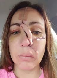 Maybe you would like to learn more about one of these? Woman S Nose Rebuilt From Forehead After She Found Tumour Inside Harmless Spot Mirror Online