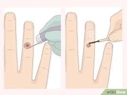 Welcome to beetlejuice, the roleplay! 5 Ways To Get Rid Of Warts Wikihow