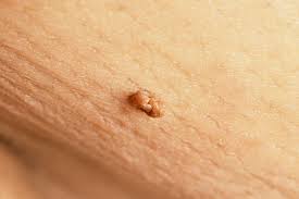 Genital Skin Tags: Symptoms, Causes, and Treatment