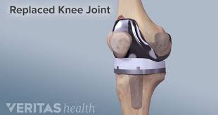 Total Knee Replacement Risks And Complications In 2020 Total Knee Replacement Knee Replacement Surgery Knee Arthritis