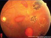 Sickle Cell Retinopathy Salmon Patch And Black Sunburst Sickle Cell Eye Anatomy Diseases Of The Eye