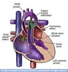 35 Hypoplastic Left Heart Syndrome Hlhs Ideas Heart Defect Syndrome Congenital Heart