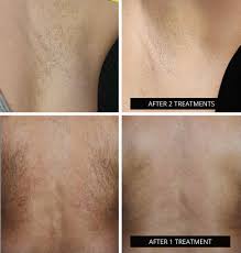 Bloom aesthetic and laser clinic has 5 medical staff across 3 specialties. Laser Hair Removal