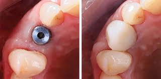 Image result for dental implant