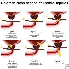 Image result for Genitourinary Trauma