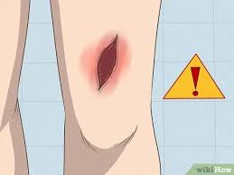 Leg ulcers are unhealed sores or open wounds on the legs. How To Treat An Open Wound 15 Steps With Pictures Wikihow