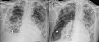 Streptococcus pneumoniae (j13) is the most common bacterial cause of pneumonia in all age groups except. Aspectos Radiologicos De La Neumonia Covid 19 Evolucion Y Complicaciones Toracicas Sciencedirect