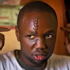 NGONG, Kenya — Anthony Omari earned the still-fresh 11-stitch scar that  runs from his forehead to his upper lip in one of the noblest ways  imaginable: By taking a machete to the