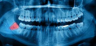 Image result for dental cancer