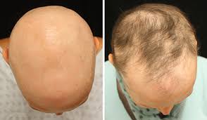 Image result for hair growth