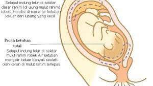 Namun, jika air ketuban anda memiliki bau yang tidak sedap atau menyengat, eric menyarankan anda untuk segera mengunjungi rumah sakit. 6 Ciri Ciri Air Ketuban Pecah Merembes Hamil Co Id