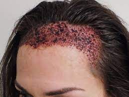 زراعة الشعر في اسطنبول بالاسعار خدمة راقية من أفضل 5 مراكز عرب تركيا