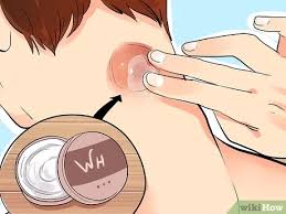 On les retire chirurgicalement quand ils sont inesthétiques ou situés dans une zone de frottement. 4 Manieres De Crever Un Kyste Wikihow