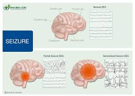 Learn about seizure types, what causes seizures, what happens focal seizures without loss of consciousness. What To Do If Your Dog Is Having A Seizure First Aid For Pets