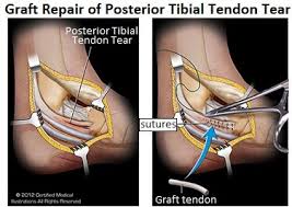 Tendon repair is done to bring back normal movement to a joint. Posterior Tibial Tendonitis Foot Pain Explored