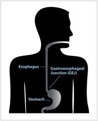 Gastroesophageal reflux disease (gerd), is a chronic condition in which stomach contents rise up into the esophagus, resulting in either symptoms or complications. About Gerd Gastroesophageal Reflux Disease