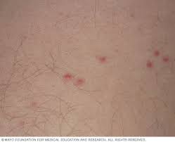 Image result for bedbugs bites