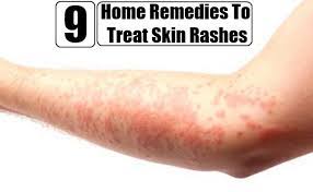 Top 9 Home Remedies To Treat Skin Rashes Home Remedies For Skin Home Remedies For Rashes Home Remedies For Allergies