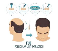 Mit der haarverpflanzung können haare an der haarausfall kann aber weiter voranschreiten. Haartransplantation Frauen Wann Sie Wirklich Hilft Kosten Faq