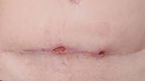The affected area might be: Mrsa Staph Infection Pictures Symptoms Treatment And Prevention