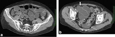 Ovarian cancer is the uncontrolled growth of abnormal cells in the ovaries. Digestive Diseases Mimicking Primary Gynecological Diseases Or With Secondary Gynecological Manifestations Sciencedirect