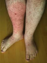 Image result for Erysipeloid