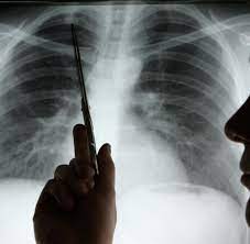 Gefahrliche Tumore Warum Die Strahlen Der Chemotherapie Uberlegen Ist Welt