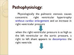 Diagnosis diagnostic study of choice. Tetralogy Of Fallot