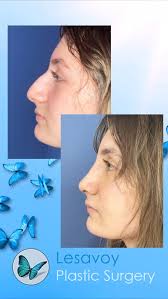 Give us a call 310-248-5451. We can help you reach your cosmetic goals! ,  #lesavoyplasticsurgery #plasticsurgery #plasticsurgeon  #beverlyhillsplasticsurgeon #beverlyhills #facelift #beforeandafter ...