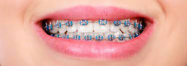 Guide To Braces In Singapore Pros And Cons Care Tips Faqs
