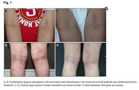 Review side effects, dosage and drug interactions prior to taking this drug. The Fungal Acne Treatment Bible 2021 Cure Malassezia With Science