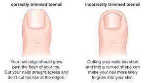 After a nail separates from the nail bed, it will not reattach, so don't try. In Grown Toenails In Pleasanton Universal City Tx Next Step Foot Ankle Clinic