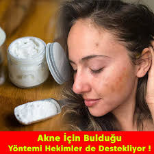Akne Probleminiz Mi Var Iste En Dogal Yontem Anti Akne Bakim Kremi Duzenli Kullanimda Cildi Yeniler P Dogal Cilt Bakimi Dogal Cilt Akne Tedavisi