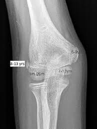 Does not contribute to longitudinal growth (apophysis). Medial Epicondyle Fractures To Fix Or Not To Fix Sciencedirect