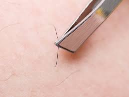 These hairs then form a bump in the skin which may be itchy or painful and can easily become infected. in some cases, an infected ingrown hair can even require. How To Get Rid Of Ingrown Hairs At Home